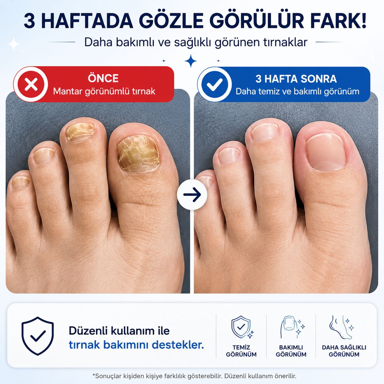 NOVENTRA LIVE® TIRNAK MANTARI TEDAVİ BANDI